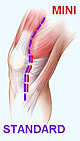 incision mini invasive